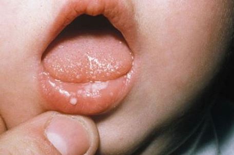 Язвенное поражение и воспаление губ