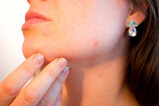 Чем лечить угревую сыпь на лице при гормональном сбое