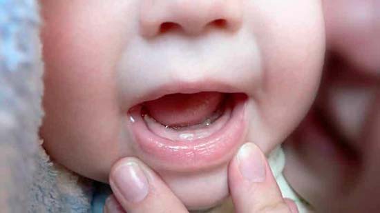Белые прыщи во рту у ребенка 2 года