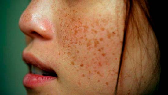 Как можно осветлить кожу на лице